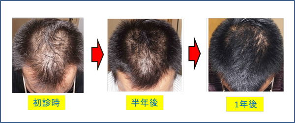 耳鍼、耳つぼジュエリー施術時の画像