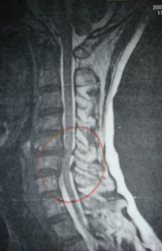 頸椎のMRI・CT・X線の画像