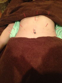 ダイエット鍼の施術時の画像