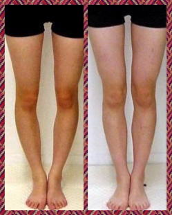 O脚のビフォーアフターの画像