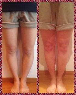 O脚矯正時のビフォーアフターの画像