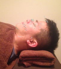 男性の美容鍼施術時の画像