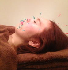 美容鍼施術時の画像